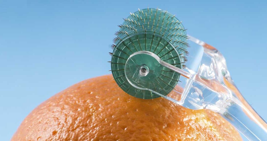 Why Microneedling Is Getting Major Face Time