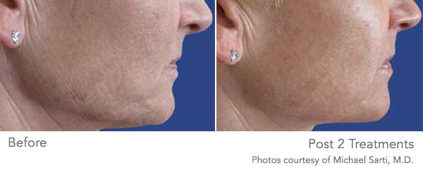 Why Secret RF Microneedling Is Getting Major Face Time